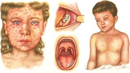 Корь аарыы бадыткаттынган бе?